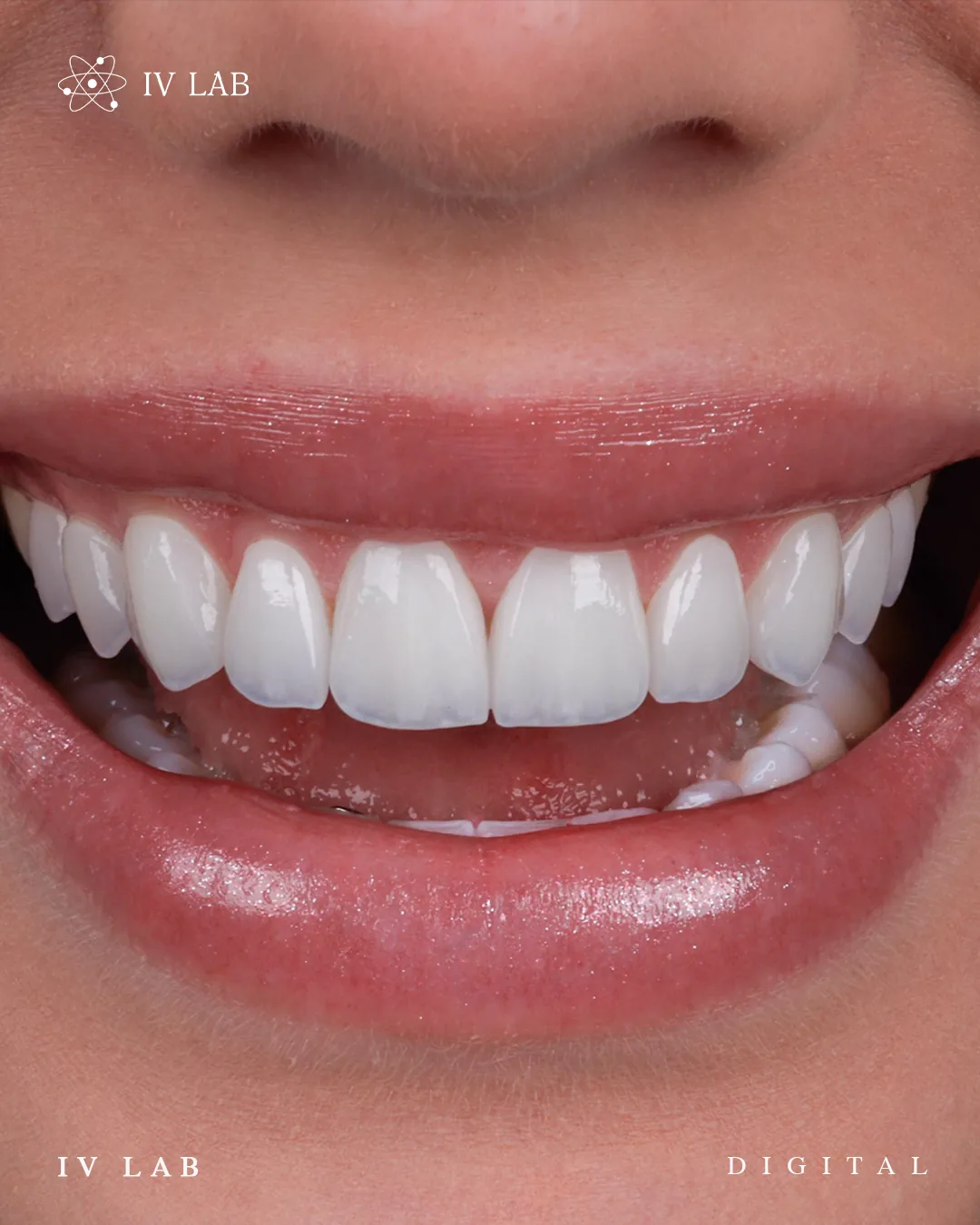 Sorriso em close com laminados cerâmicos de aparência natural