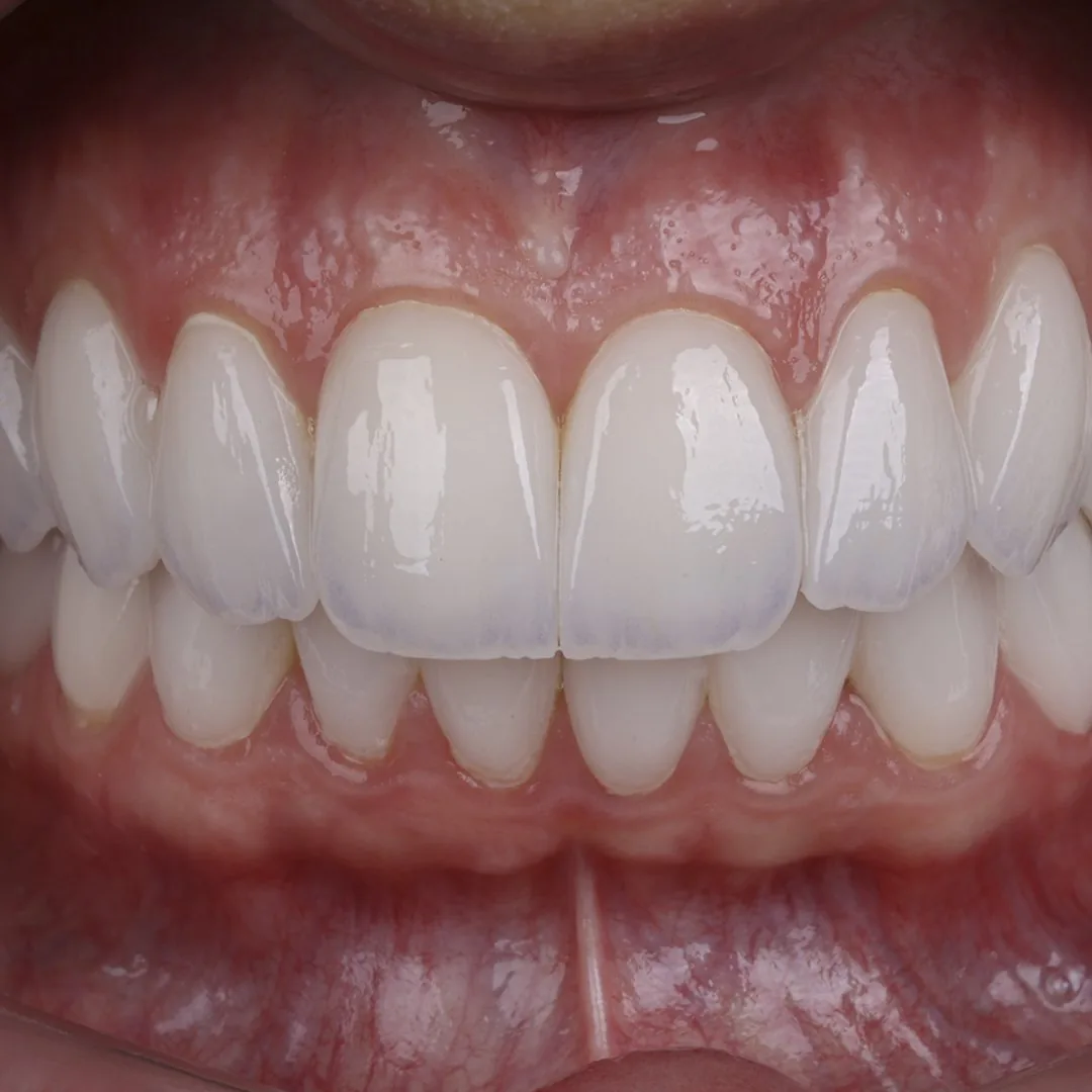 Laminados cerâmicos instalados, com resultado natural em sorriso real