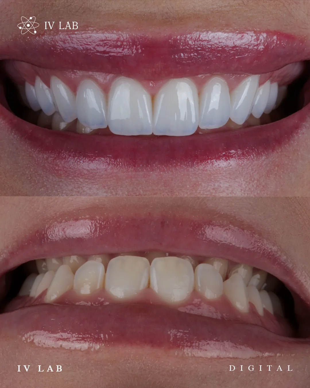 Reabilitação estética completa